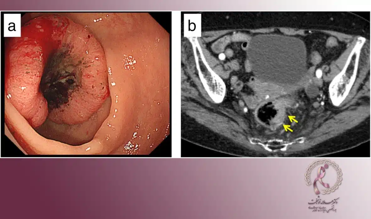 درمان سرطان رکتوم