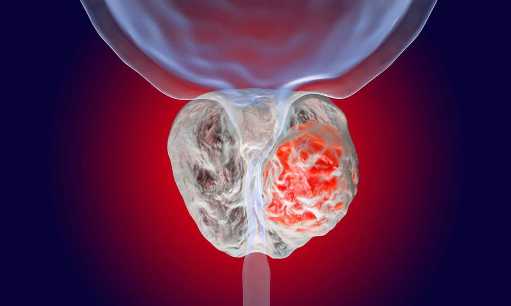 سرطان پروستات